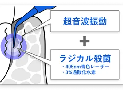 ブルーラジカル治療による超音波振動とラジカル殺菌のWアプローチで細菌を完全に死滅させるイメージ