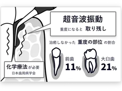 超音波振動のみによる従来の歯周病治療で細菌の取り残しが発生しやすい問題を示すイメージ