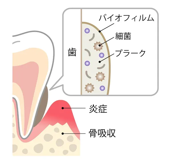 歯周ポケット内部の歯根の表面に頑固に付着した細菌の塊（バイオフィルム）の顕微鏡イメージ